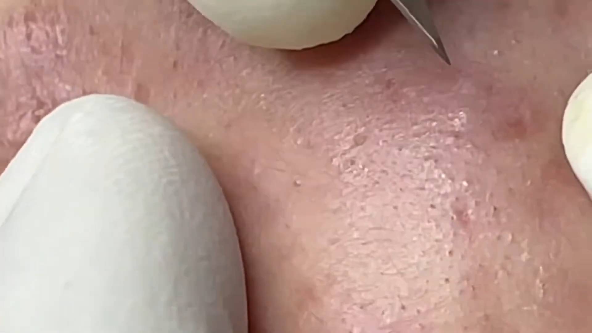 Asmr. Очищение лица от акне и сальных пробок. #7 смотреть онлайн