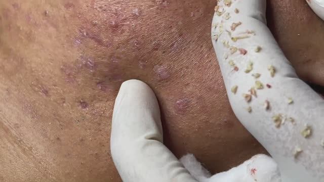 Asmr. Очищение лица от черных точек. #9 смотреть онлайн