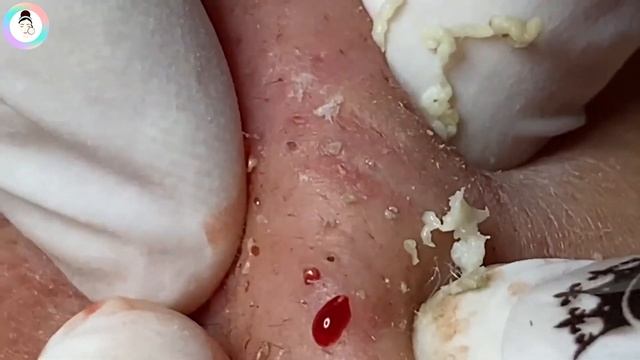 Чёрные точки и комедоны на щеках. Расслабляйтесь от выдавливания! #уходзалицом смотреть онлайн