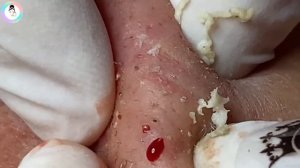 Чёрные точки и комедоны на щеках. Расслабляйтесь от выдавливания! #уходзалицом