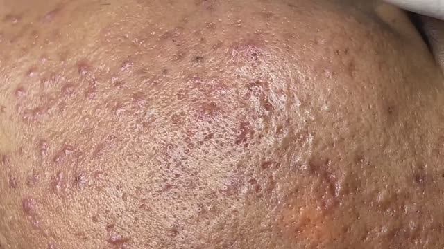 Asmr. Профессиональная чистка от прыщей и сальных пробок. #8 смотреть онлайн