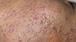 Asmr. Профессиональная чистка от прыщей и сальных пробок. #8