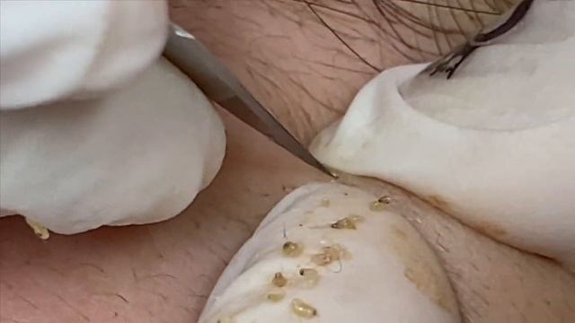 Чистка чёрных точек для девушки - SDS#132 смотреть онлайн