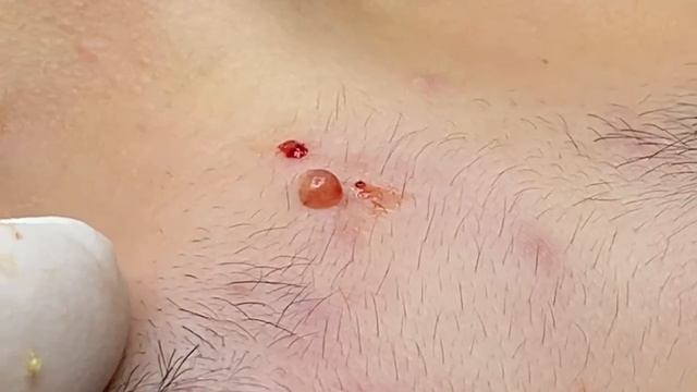 Акне в переходном возрасте- SDS#135 смотреть онлайн