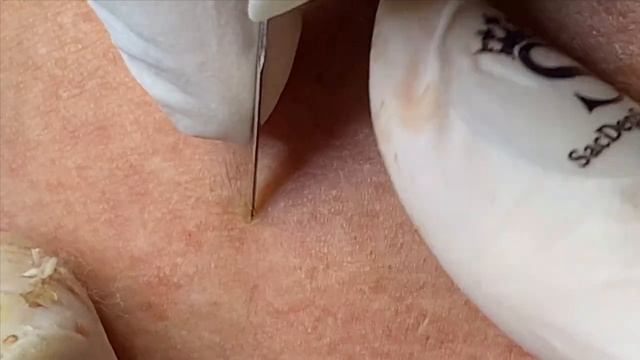 Акне в области уха: как с ними бороться? - SDS#136 смотреть онлайн