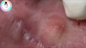 Гигантский прыщ за ухом! Выдавливаем огромный комедон и воспаленный угорь