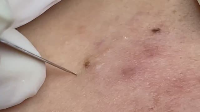 Спасение кожи от чёрных точек - SDS#133 смотреть онлайн