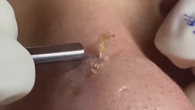 Избавление от черных точек: чистые поры за 7 дней. смотреть онлайн