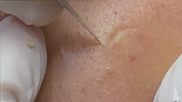 Акне, вызванное нарушением гормонального фона - SDS#130 смотреть онлайн