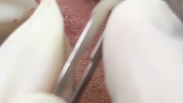 Выдавливание прыщей, угрей, черных точек и камедонов #66 смотреть онлайн