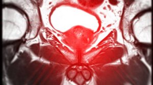 САМЫЙ ПОЗНАВАТЕЛЬНЫЙ КАНАЛ. ВСЁ О РАКЕ ПРОСТАТЫ.