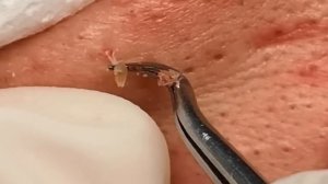 Чистка лица от угрей и акне. Выдавливание прыщей. Удаление черных точек и комедонов