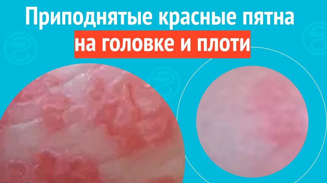 😡 Приподнятые красные пятна на головке и плоти. Клинический случай № 1725 смотреть онлайн