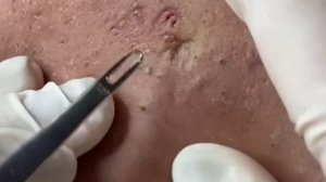 Чистка лица от угрей и акне. Выдавливание прыщей. Удаление черных точек и комедонов