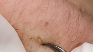 Чистка лица от угрей и акне. Выдавливание прыщей. Удаление черных точек и комедонов