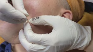 Прыщи на шее и щеках, Часть 2 - SDS#140