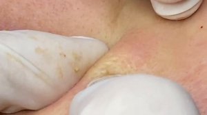 Удаление застарелых, стойких черных точек SDS#140