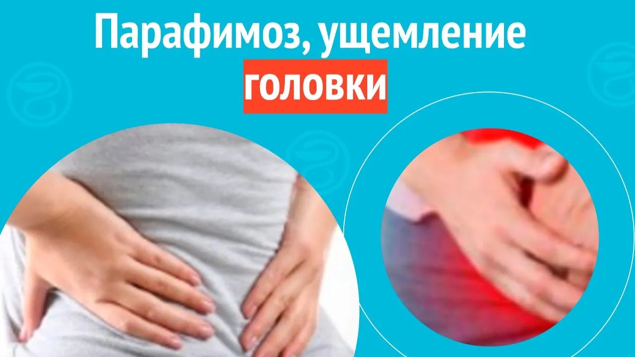 🙁 Парафимоз, ущемление головки. Клинический случай № 1724 смотреть онлайн