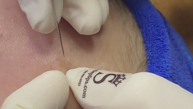 Удаление прыщей на лбу для девушек - SDS#141 смотреть онлайн