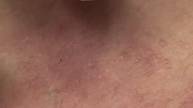 Удаление подкожных прыщей, комедонов - SDS#145 смотреть онлайн