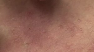 Удаление подкожных прыщей, комедонов - SDS#145