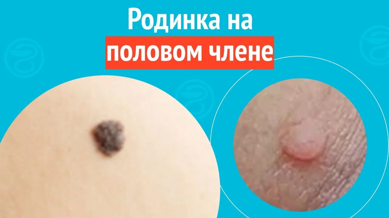 👉 Родинка на половом члене. Клинический случай № 1732 смотреть онлайн