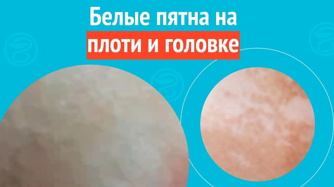 ➡️ Белые пятна на плоти и головке. Клинический случай № 1720 смотреть онлайн