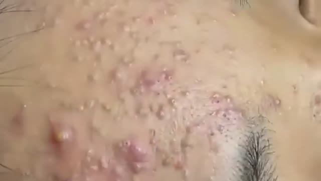 Успокаивающее удаление черных точек: извлечение крупных кист и белых угрей смотреть онлайн