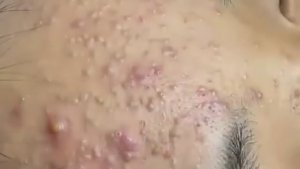 Успокаивающее удаление черных точек: извлечение крупных кист и белых угрей