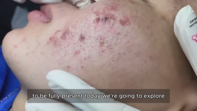 Профессиональная чистка от комедонов. Безопасно #10015903 смотреть онлайн