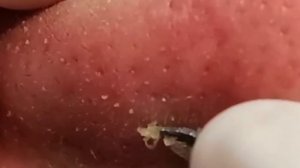 Чистка лица от угрей и акне. Выдавливание прыщей. Удаление черных точек и комедонов