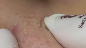 Быстрое избавление от черных точек - SDS#143