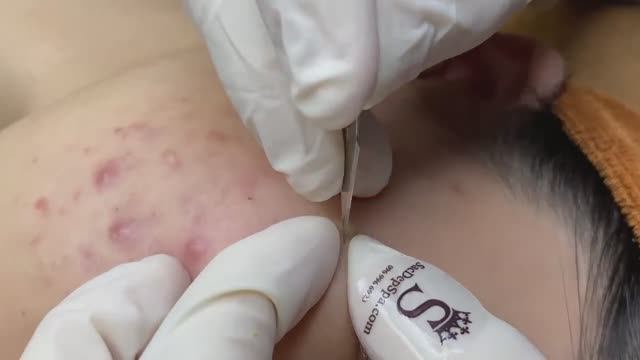 Лечение болезненных подкожных прыщей - SDS#147 смотреть онлайн