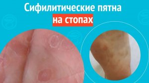 🦶 Сифилитические пятна на стопах. Клинический случай № 1727