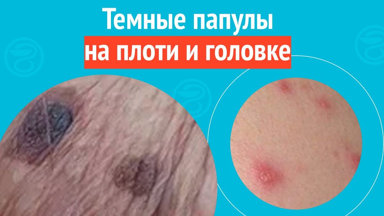 👉 Темные папулы на плоти и головке. Клинический случай № 1726 смотреть онлайн