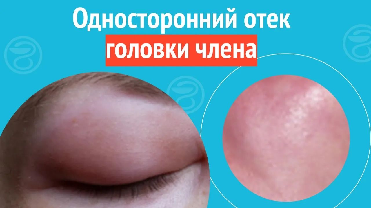 😦 Односторонний отек головки члена. Клинический случай № 1718 смотреть онлайн