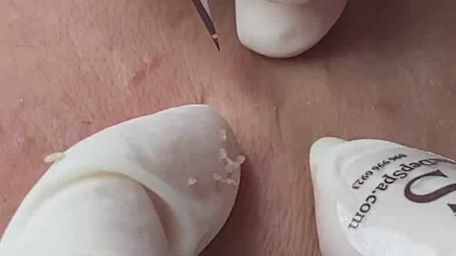 Акне из-за изменения гормонов - SDS146 смотреть онлайн