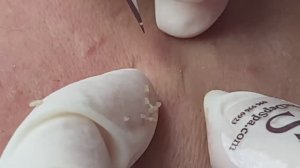 Акне из-за изменения гормонов - SDS146