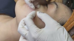 Акне в период полового созревания у девушек. SDS#142