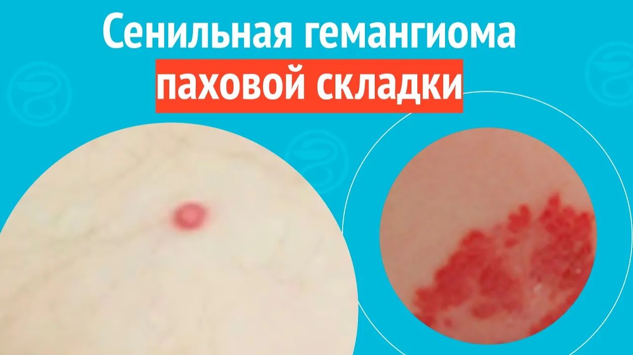 ➡️ Сенильная гемангиома в паховой складке. Клинический случай № 1722 смотреть онлайн