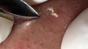 Часовая чистка лица пинцетом: удаление черных точек