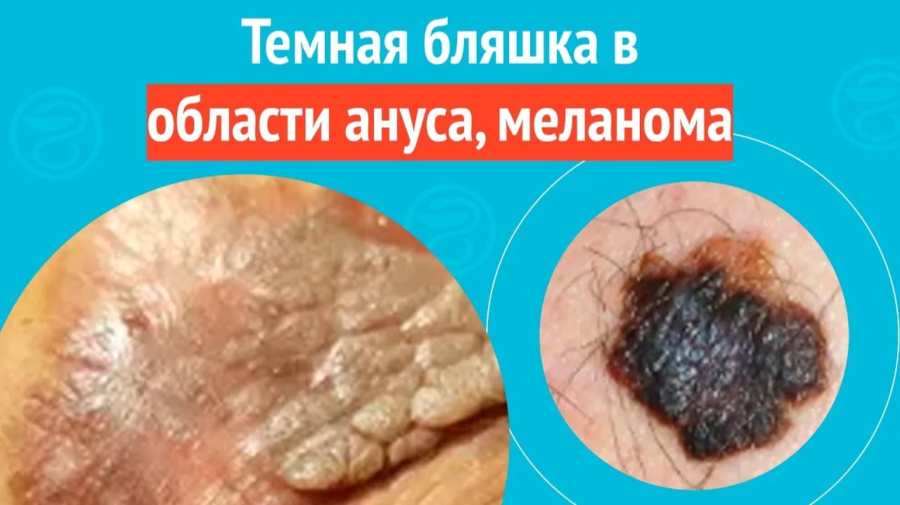 😟 Темная бляшка в области ануса, меланома. Клинический случай № 1719 смотреть онлайн