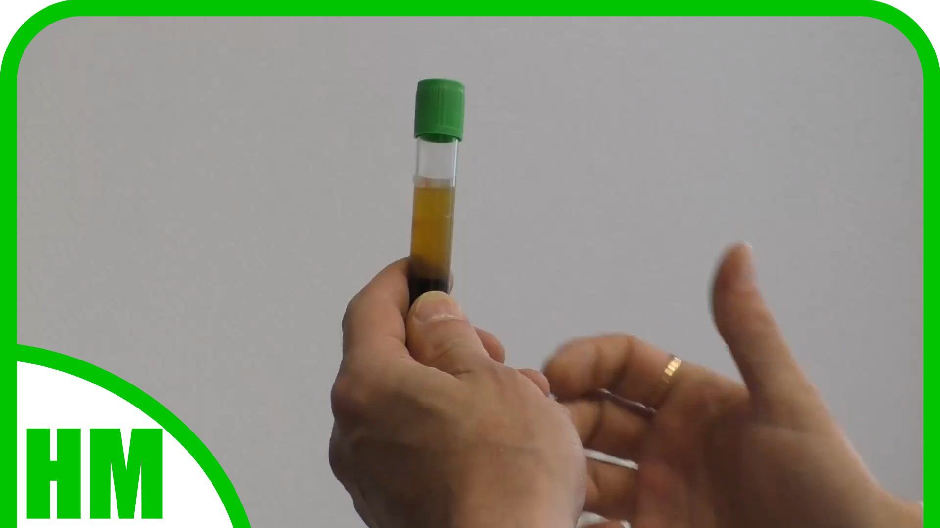 Архив. 2023г. Шикарный метод для больных суставов. Плазмотерапия. PRP-терапия. Боль уходит 🙏 смотреть онлайн