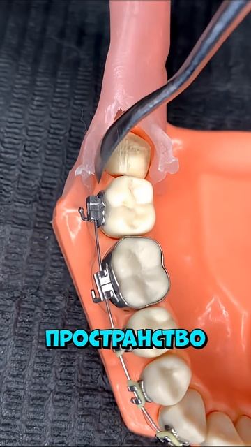 Зуб растёт не туда： вот почему его срочно удаляют #shorts