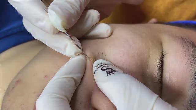 Очистка черных точек на щеках и лбу SDS#142 смотреть онлайн