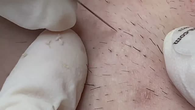 Удаление скрытых прыщей под кожей - SDS#144 смотреть онлайн