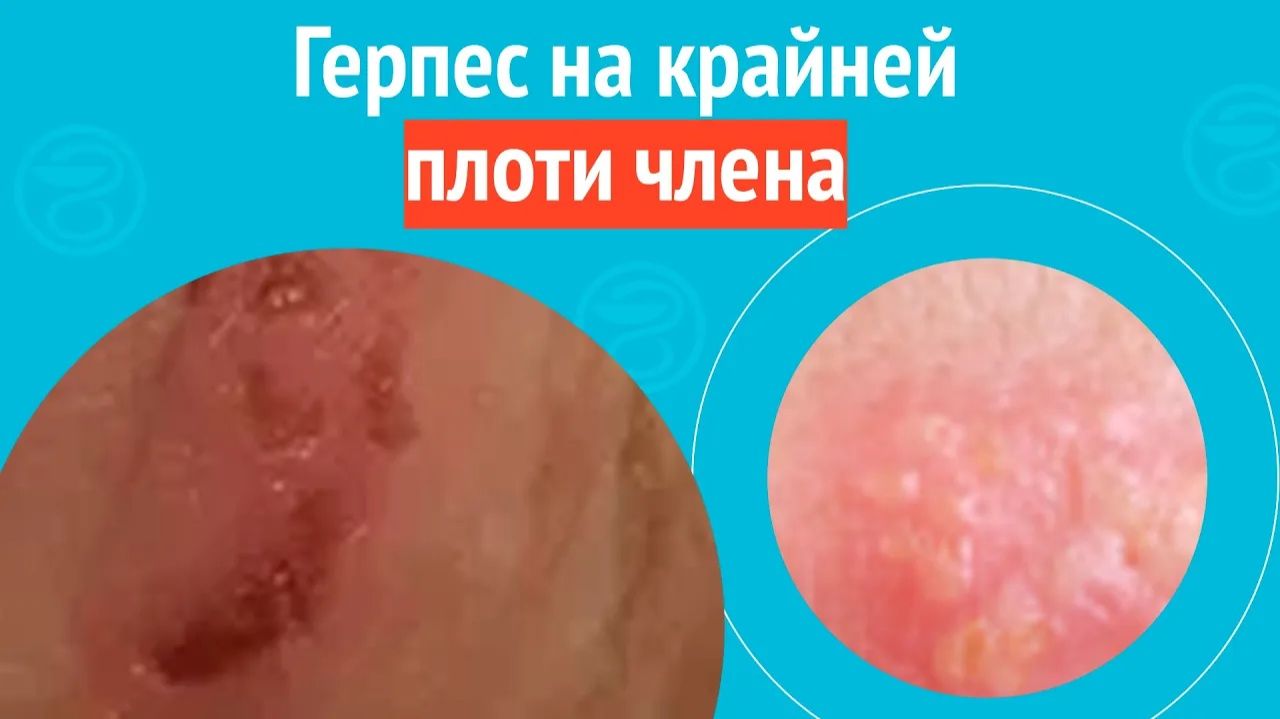 🥺 Герпес на крайней плоти члена. Клинический случай № 1723 смотреть онлайн