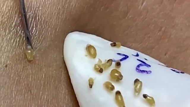 Выдавливание прыщей, угрей, черных точек и камедонов #72 смотреть онлайн