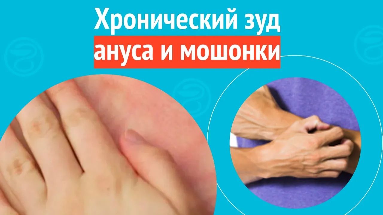 ➡️ Хронический зуд ануса и мошонки. Клинический случай № 1731 смотреть онлайн