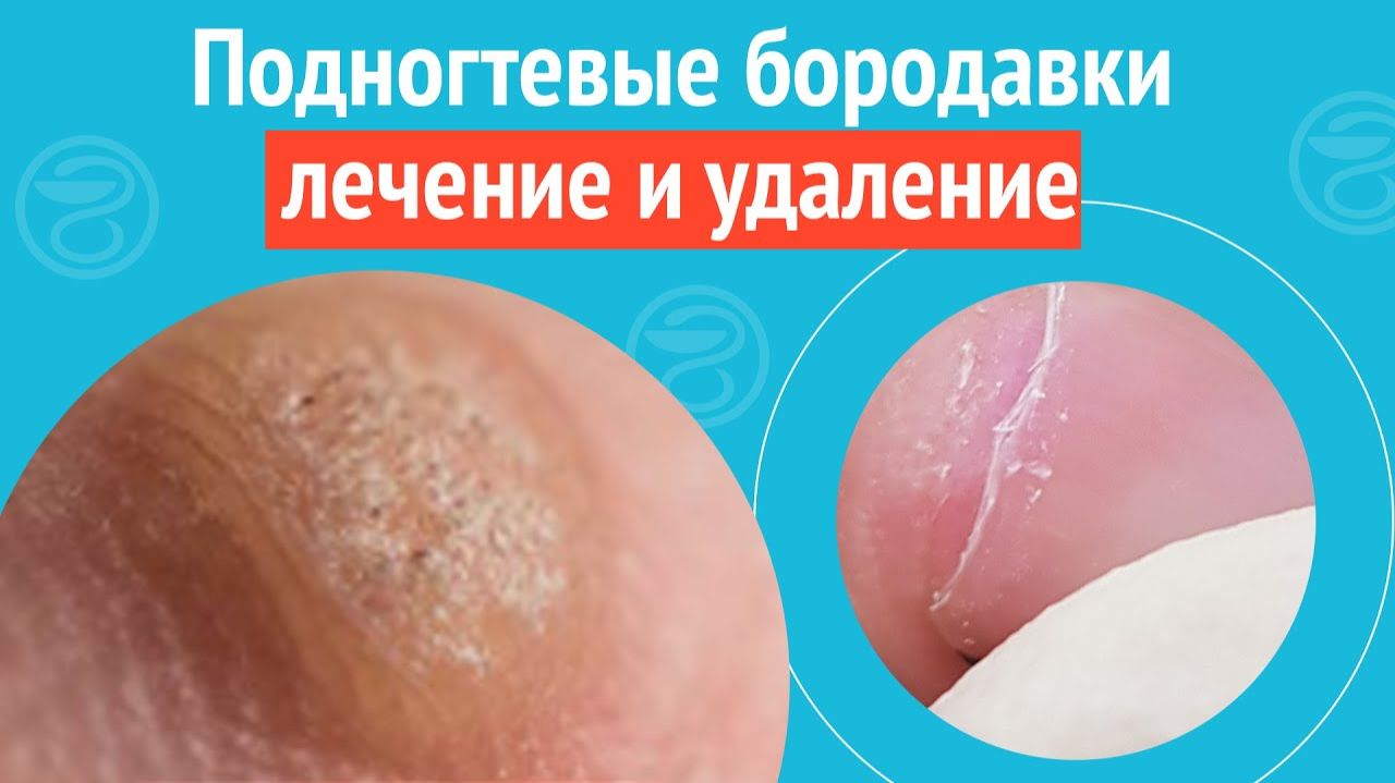 ✋ Подногтевые бородавки, лечение и удаление. Клинический случай №1702 смотреть онлайн